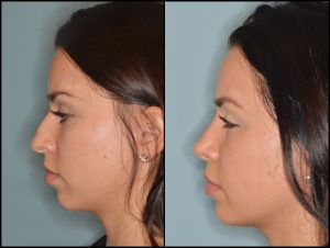 Before and After: Rhinoplasty