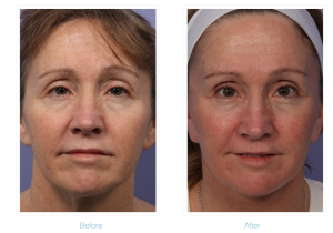 Facelift: Before and After