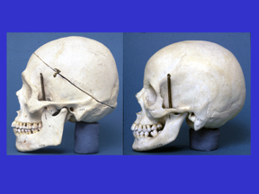 (Note; these images have been provided by my colleague, Dr. Douglas Ousterhout are taken from the Atkinson Skull Collection, University of the Pacific School of Dentistry, Webster Street, San Francisco, California)