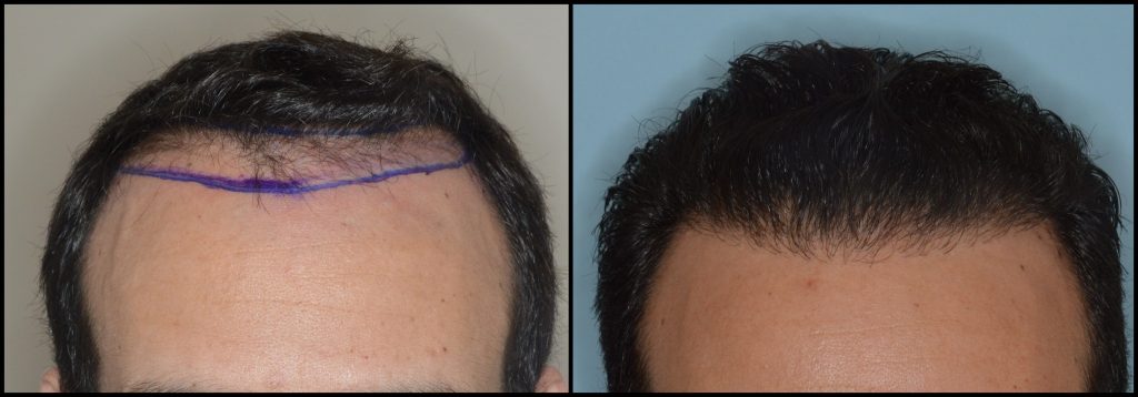 Before and After: Hair Transplant