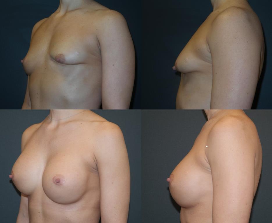 The patient had 7 previous failed breast augmentation surgeries by another doctor. Dr. Schwartz gave her the natural fullness that she wanted using gummy bear implants and acellular dermal matrix in 1 surgery.