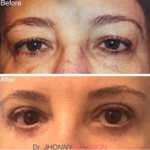 55-year-old patient before and three months after upper and lower blepharoplasty.