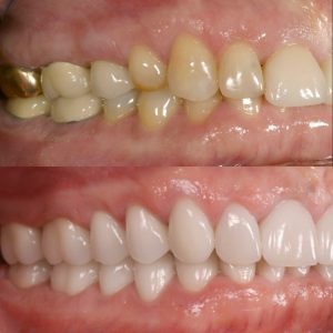 Full-mouth rehab with new veneers and all-ceramic crowns.