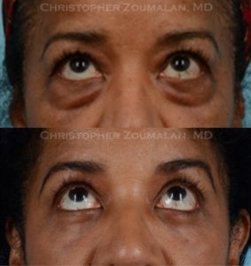 Before and after upper and lower blepharoplasty.