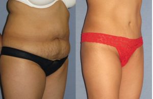 Before and after yummy tuck surgery.