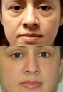Before and two months after upper and lower blepharoplasty, left ptosis repair and a mid-face lift.