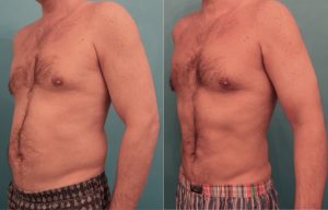Before and six months after SmartLipo (laser liposuction) of the upper abdomen, lower abdomen, and love handles. 
