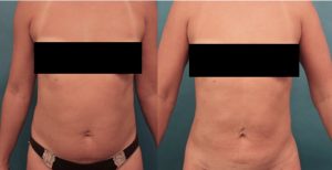 Before and six months after liposuction to the upper and lower abdomen, waist, and upper back. 