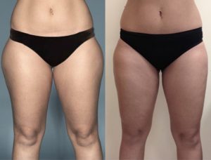 Before and one year after liposuction of the inner and outer thighs.