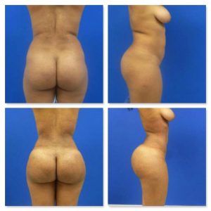 23-year-old patient before (top row) and after (bottom row) a Brazilian butt lift via fat transfer.