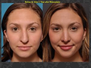 This 21-year-old suffered an injury while playing sports that resulted in a crooked nose and the inability to breathe well . Results shown are after septorhinoplasty to restore proper breathing and a straighter, uninjured appearance. 