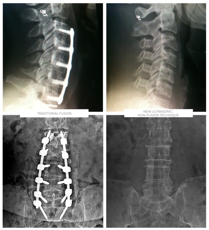 Ultrasonic Spine Surgery