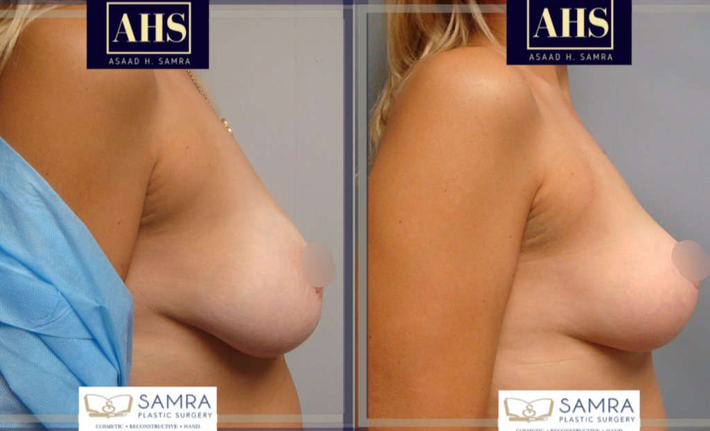 Dr. Samra breast lift 1