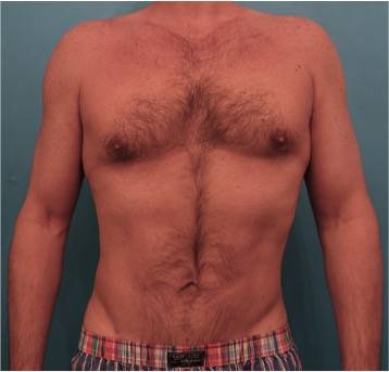 male-liposuction-1-after-1