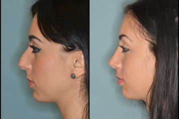 Dr. Anthony Bared Shares Tips for Choosing a Rhinoplasty Surgeon