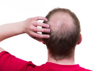 Considering A Hair Transplant? FAQs from Dr. Bared