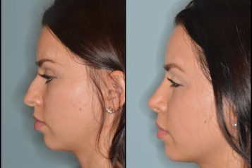 Dr. Anthony Bared Shares How To Achieve Natural-Appearing Results In Rhinoplasty