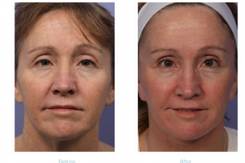 Dr. Grant Stevens Shares Tips for a Successful Facelift