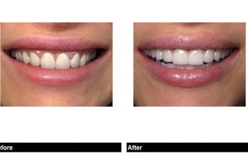 Perfect Porcelain Veneer Tooth Shapes For Your New Smile