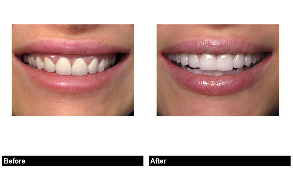 Perfect Porcelain Veneer Tooth Shapes For Your New Smile