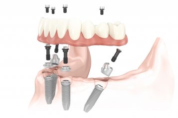 Dr. Arthur Glosman: How does all-in-one dental implants treatment compare to the traditional approach