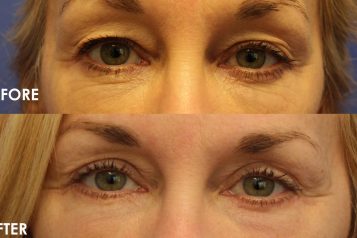 Dr. Lisa DiFrancesco: Is Eyelid Surgery for You and What to Expect