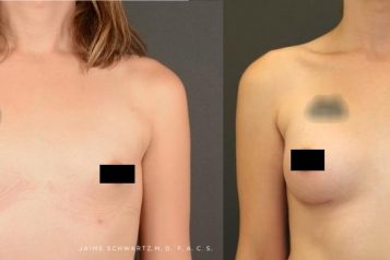 Dr. Jaime Schwartz: 5 Things You Probably Don’t Know About Male To Female Transgender Top Surgery