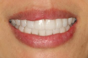 Dr. Randy Furshman: Achieving A Movie-Star Smile With Veneers