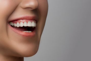 Veneers: The Step-by-Step Process