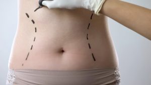 Tummy tuck