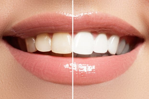 Why Spring Cleaning Should Include Your Teeth - Haute Beauty by Haute ...