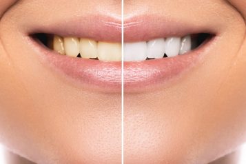 How To Maintain Your Picture Perfect Smile After Whitening Treatment