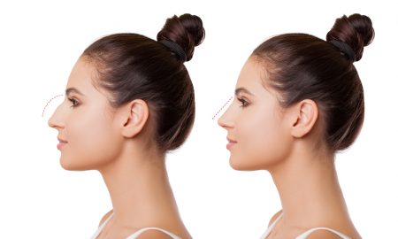 rhinoplasty