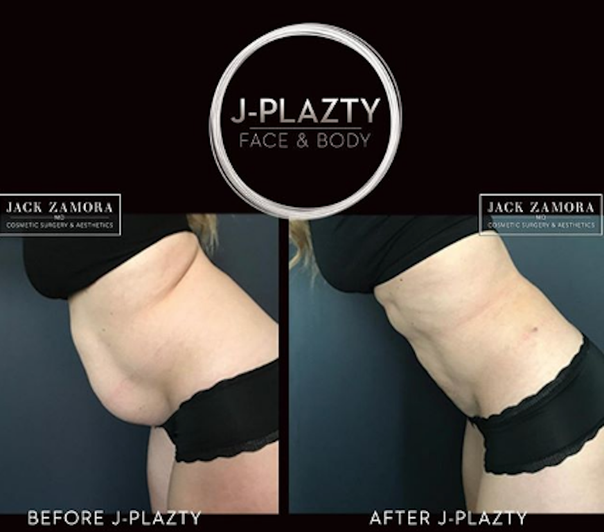 J- Plazty: The Gold Standard For Skin Tightening