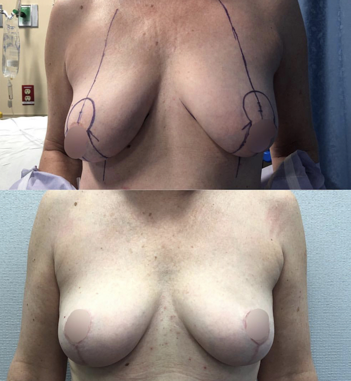 breast augmentation