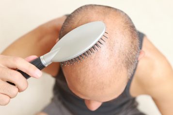 neograft for hair loss