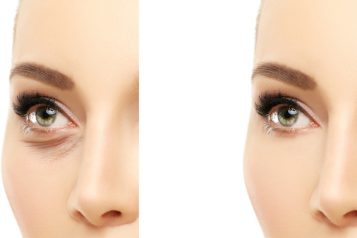 Lower Eyelid surgery