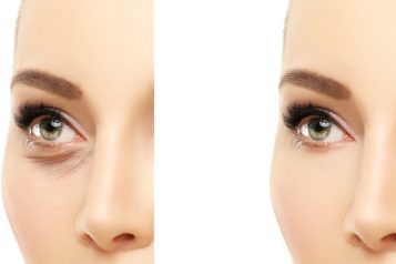 Dr. Mehta Tells You Everything You Need To Know About Lower Eyelid Surgery