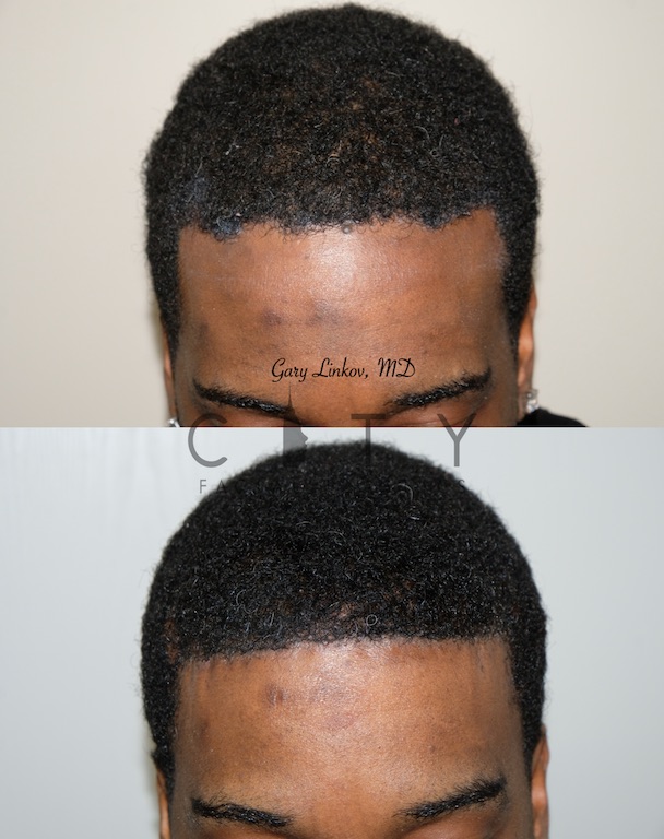 Surgical hairline advancement