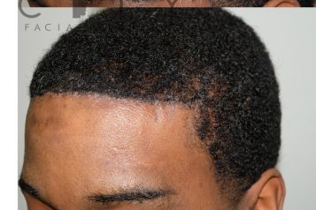 Surgical Hairline Advancement 2