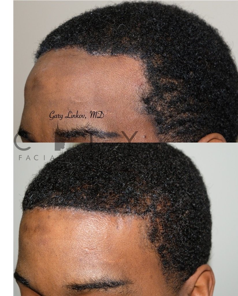 Surgical Hairline Advancement