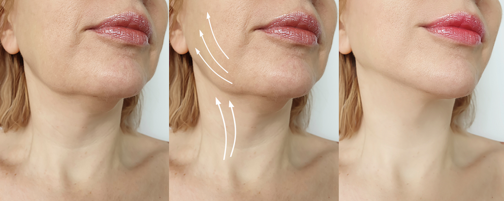 Lower face and Neck lift 