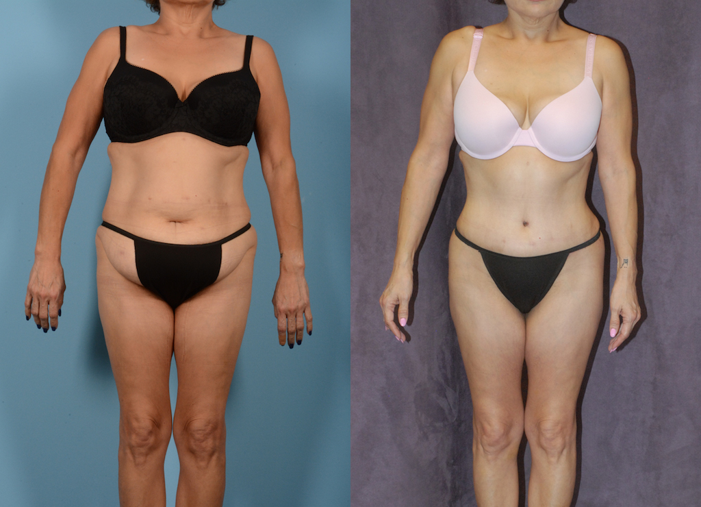 before and after tummy tuck in clothes