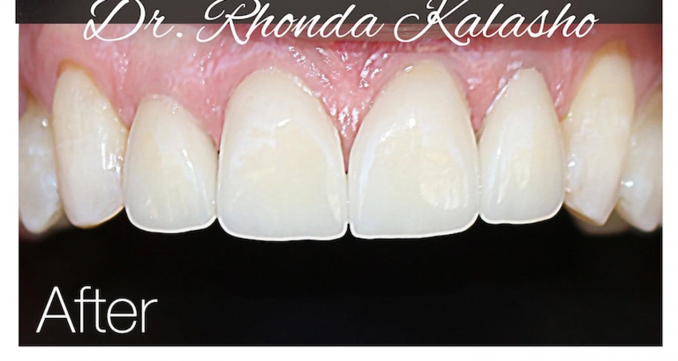 Replacing Your Old Veneers Or Crowns
