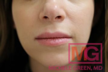 juvederm-before-after-4577-MGwatermark