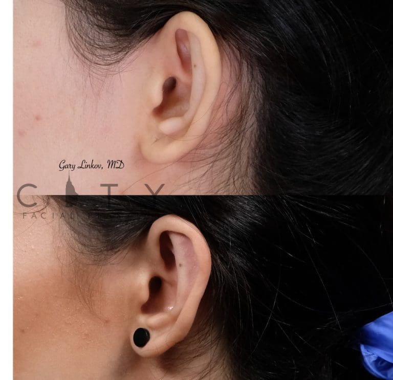 Here's What You Need To Know About Ear Pinning According to Dr. Linkov