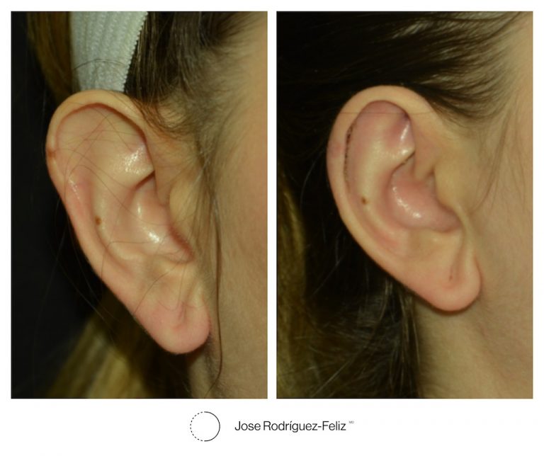 if-you-have-ever-wanted-smaller-ears-macrotia-ear-surgery-is-for-you