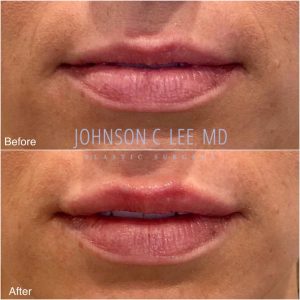 injectables Lips
