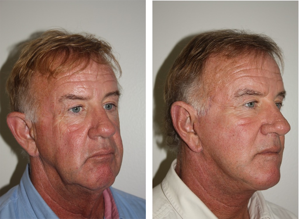 Orange County Male Facelift