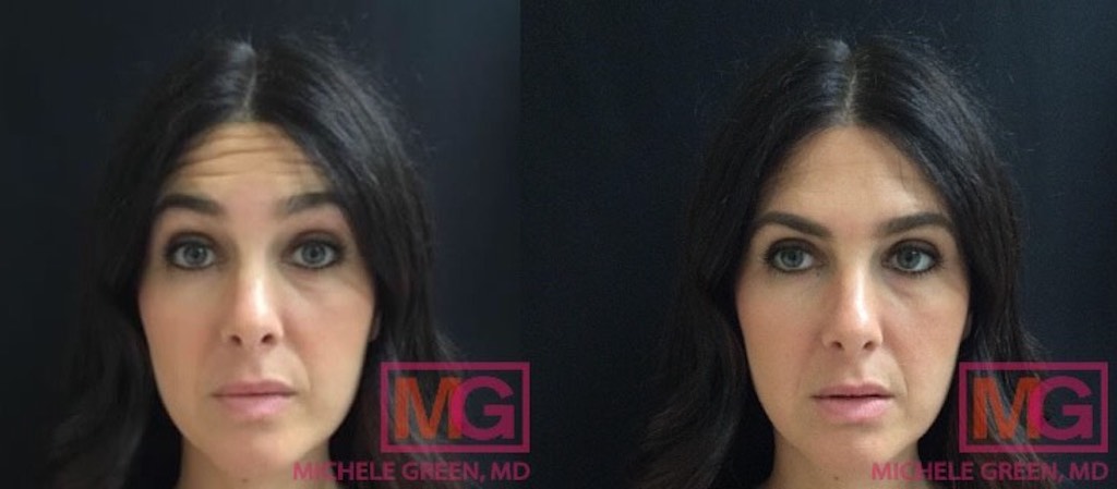 Fillers Dr. Michele green